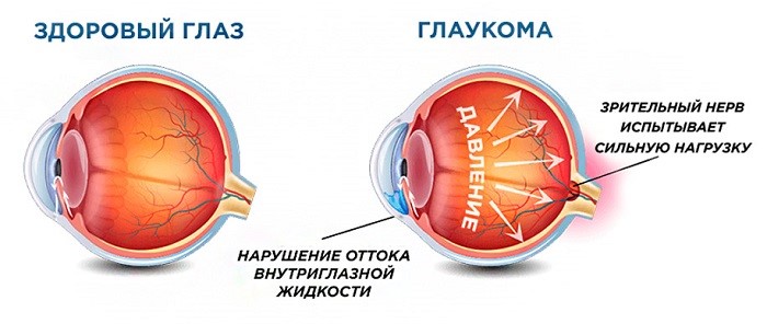 Что такое глаукома и методы её лечения